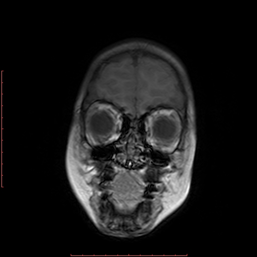 File:Astroblastoma (Radiopaedia 74287-85162 Coronal T1 2).jpg
