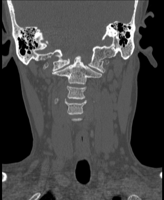 Atlanto-occipital assimilation with basilar invagination (Radiopaedia 70122-80188 Coronal bone window 79).jpg