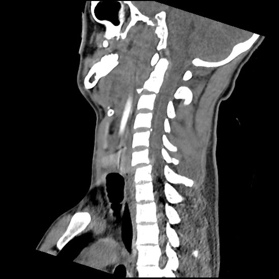 Atlanto-occipital dissociation (Traynelis type 1), C2 teardrop fracture, C6-7 facet joint dislocation (Radiopaedia 87655-104061 D 48).jpg