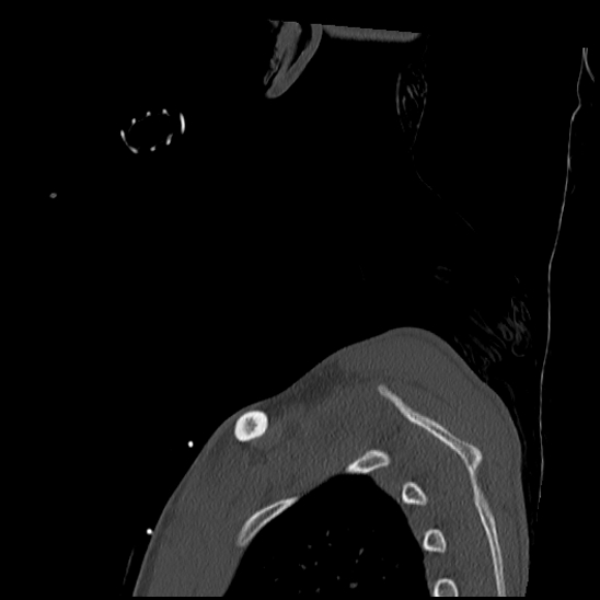 Atlanto-occipital dissociation (Traynelis type 1), C2 teardrop fracture, C6-7 facet joint dislocation (Radiopaedia 87655-104061 Sagittal bone window 76).jpg