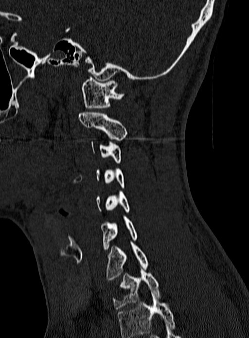 Atlantoaxial subluxation (Radiopaedia 44681-48450 Sagittal bone window 122).jpg