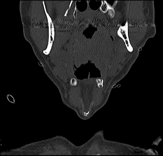 File:Atlas (type 3b subtype 1) and axis (Anderson and D'Alonzo type 3, Roy-Camille type 2) fractures (Radiopaedia 88043-104607 Coronal bone window 1).jpg