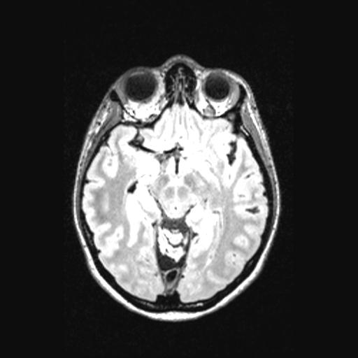 Atretic encephalocoele with inferior vermis hypoplasia (Radiopaedia 30443-31108 Axial 70).jpg