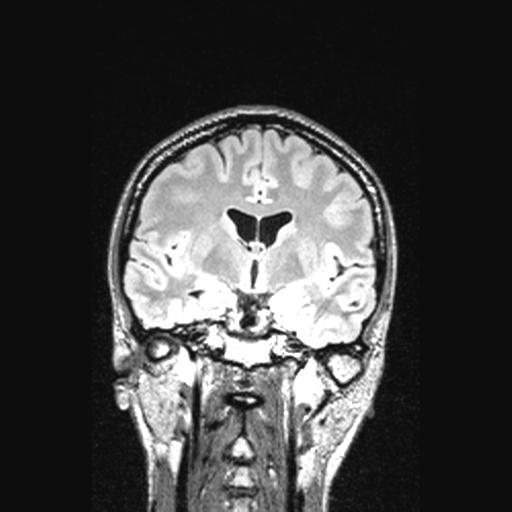 Atretic encephalocoele with inferior vermis hypoplasia (Radiopaedia 30443-31108 Coronal FLAIR 102).jpg