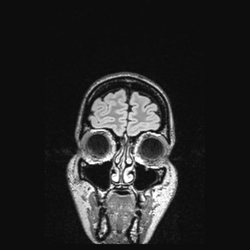 Atretic encephalocoele with inferior vermis hypoplasia (Radiopaedia 30443-31108 Coronal FLAIR 161).jpg