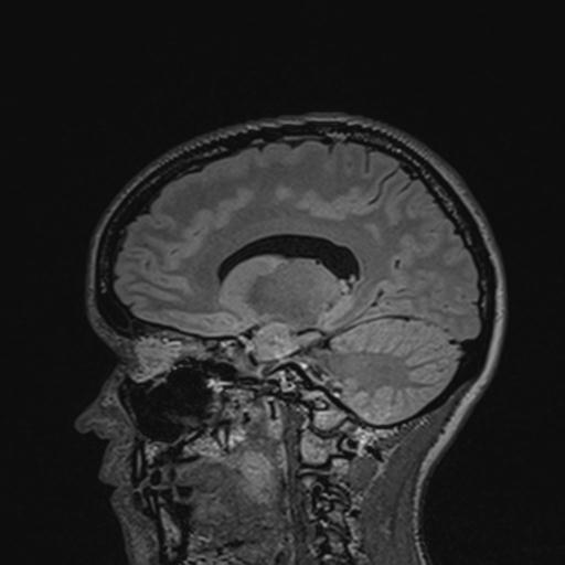 Atretic encephalocoele with inferior vermis hypoplasia (Radiopaedia 30443-31108 Sagittal FLAIR 69).jpg
