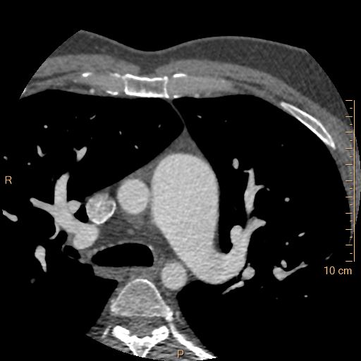 File:Atrial septal defect (upper sinus venosus type) with partial anomalous pulmonary venous return into superior vena cava (Radiopaedia 73228-83961 A 35).jpg