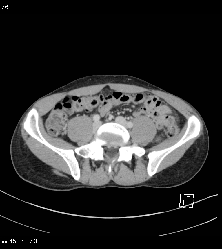 Atypical acute epiploic appendagitis (Radiopaedia 55479-61943 A 75).jpg