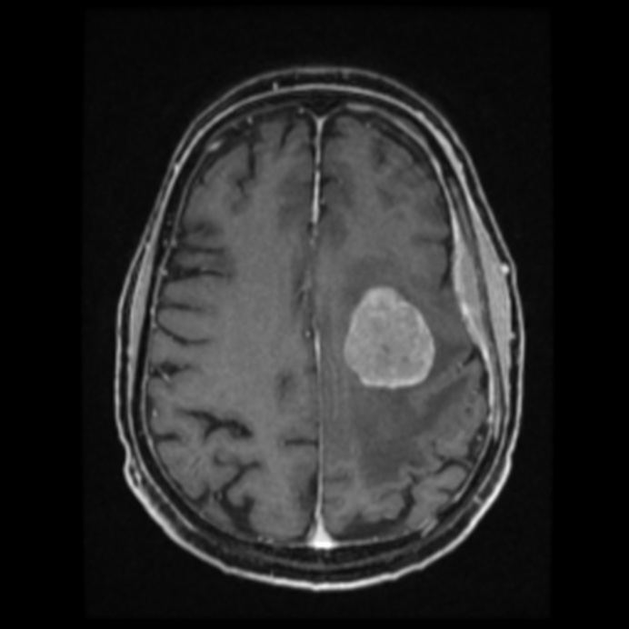 Atypical meningioma (Radiopaedia 45535-49629 Axial T1 C+ 48).jpg