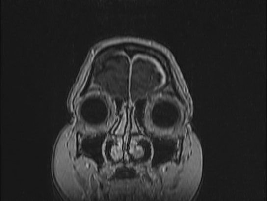 Atypical meningioma (Radiopaedia 62985-71406 Coronal T1 C+ 6).jpg