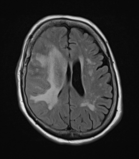 File:Atypical meningioma (WHO Grade II) (Radiopaedia 54742-60981 Axial FLAIR 18).png
