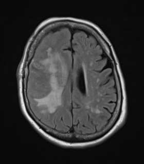 File:Atypical meningioma (WHO Grade II) (Radiopaedia 54742-60981 Axial FLAIR 19).png