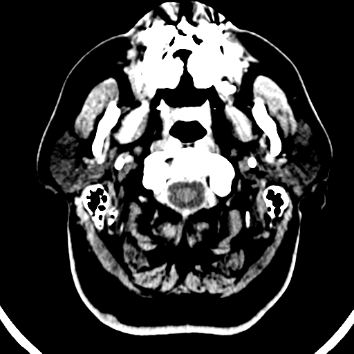 Atypical meningioma (WHO grade II) with brain invasion (Radiopaedia 57767-64728 Axial C+ 55).png