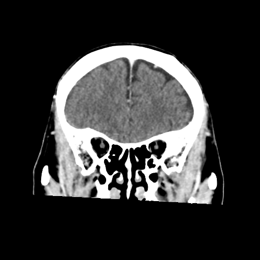 File:Atypical meningioma (WHO grade II) with osseous invasion (Radiopaedia 53654-59715 Coronal C+ delayed 17).png