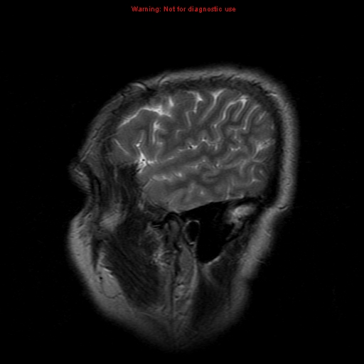 File:Atypical meningioma - grade II (Radiopaedia 13303-13305 Sagittal T2 20).jpg