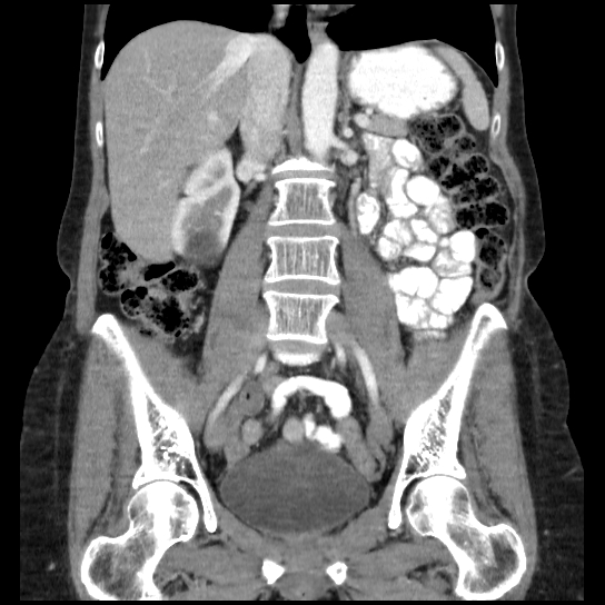 File:Atypical renal cyst (Radiopaedia 17536-17251 C 18).jpg