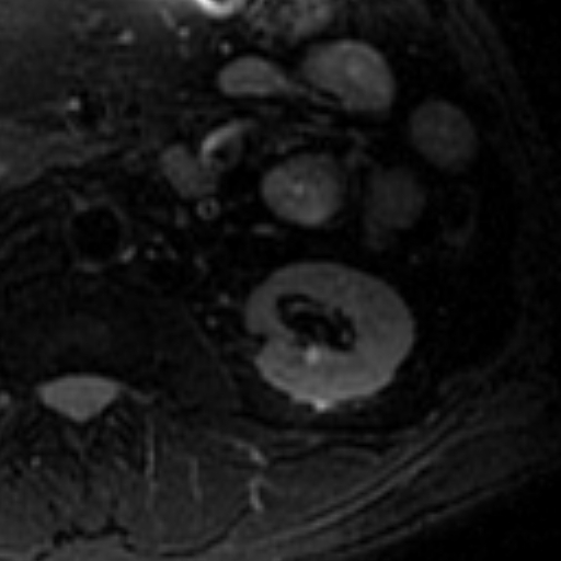 File:Atypical renal cyst on MRI (Radiopaedia 17349-17046 Axial T2 fat sat 15).jpg