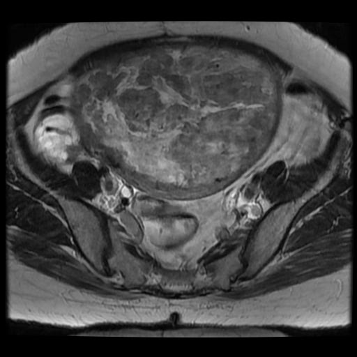 File:Atypical retroperitoneal lymphocoeles with large leiomyoma of uterus (Radiopaedia 32084-33027 Axial T2 17).jpg