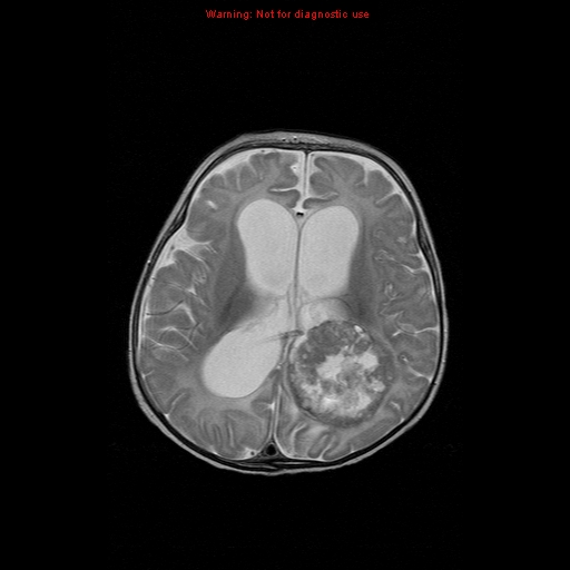 File:Atypical teratoid rhabdoid tumor (Radiopaedia 10712-11183 Axial T2 7).jpg