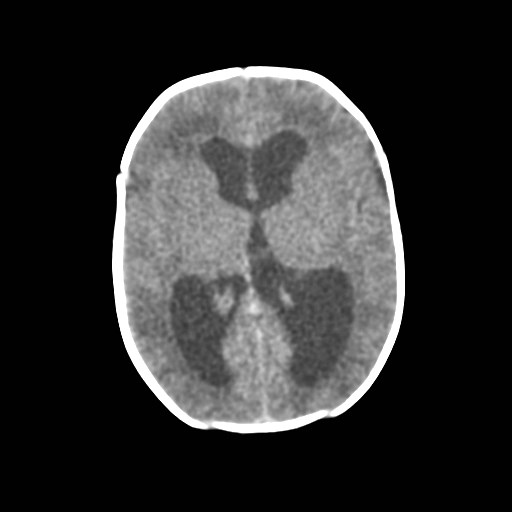 File:Atypical teratoid rhabdoid tumor (prenatal US and neonatal MRI) (Radiopaedia 59091-66387 Axial non-contrast 22).jpg