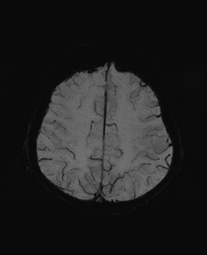 Autoimmune limbic encephalitis (Radiopaedia 30363-31005 SWI - mIP 54).jpg