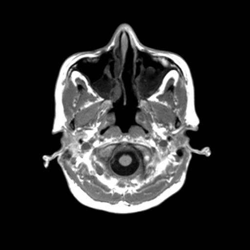 Autoimmune limbic encephalitis (Radiopaedia 30363-31005 T1 Axial 3mm 6).jpg