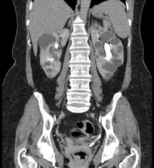 Autosomal dominant polycystic kidney disease (Radiopaedia 38189-40194 Coronal C+ delayed 64).jpg