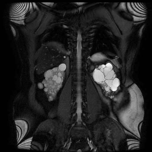 File:Autosomal dominant polycystic kidney disease (Radiopaedia 50259-55611 Coronal FIESTA 25).jpg