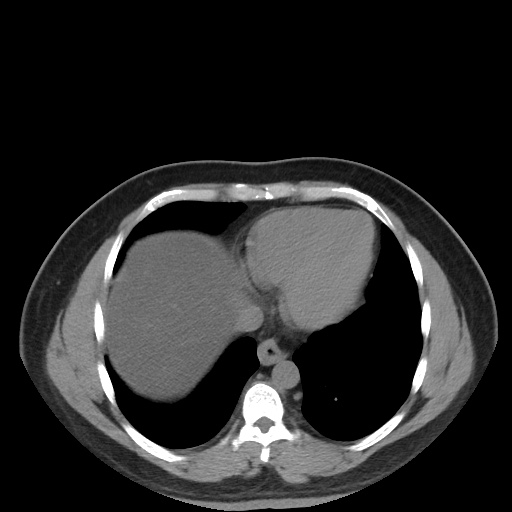 Autosomal dominant polycystic kidney disease (Radiopaedia 50259-55612 Axial non-contrast 12).jpg