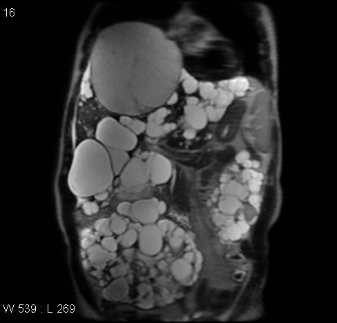 File:Autosomal dominant polycystic kidney disease (Radiopaedia 5202-6969 Coronal T2 5).jpg