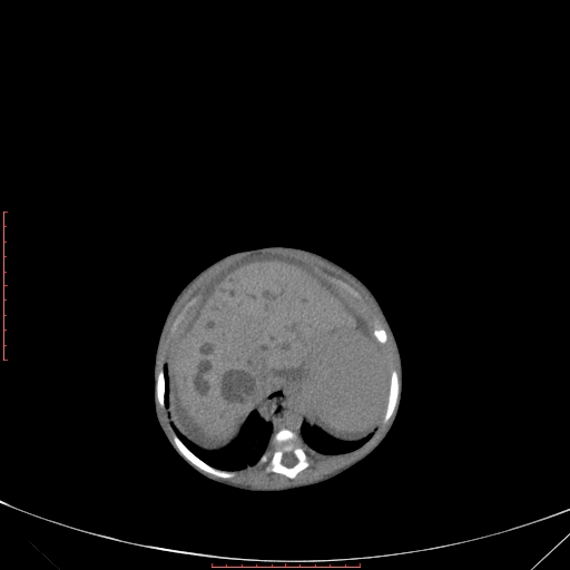 File:Autosomal recessive polycystic kidney disease associated with Caroli disease (Radiopaedia 61932-69984 B 110).jpg