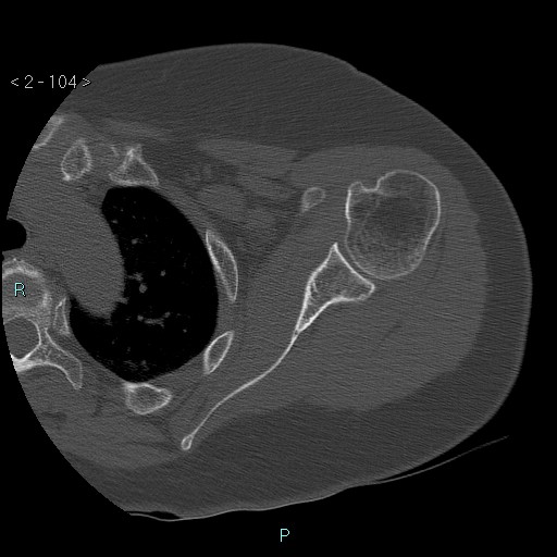 Avascular necrosis of the shoulder - Cruess stage I (Radiopaedia 77674-89887 Axial bone window 26).jpg