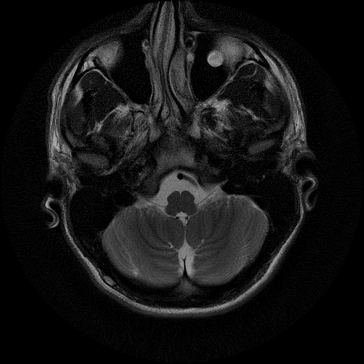 File:Azygos anterior cerebral artery (Radiopaedia 17059-16756 Axial T2 21).jpg