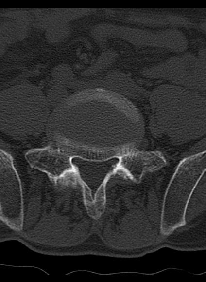 File:Baastrup syndrome (Radiopaedia 64891-73838 Axial bone window 14).jpg