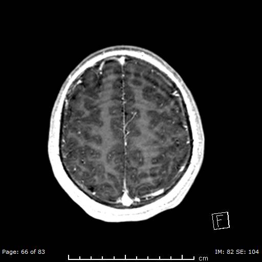Balo concentric sclerosis (Radiopaedia 61637-69636 Axial T1 C+ 66).jpg