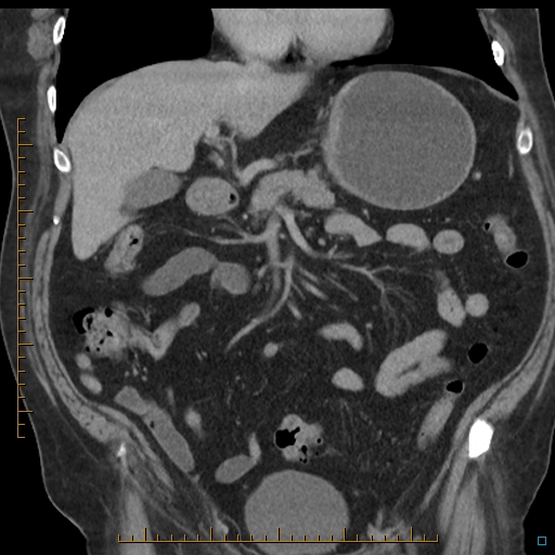 File:Bariatric balloon causing gastric outlet obstruction (Radiopaedia 54449-60672 B 24).jpg