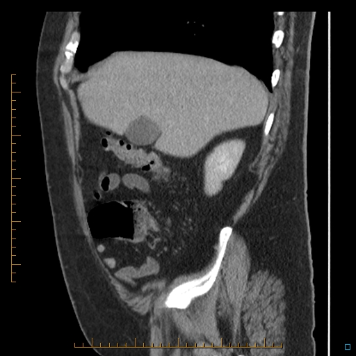 Bariatric balloon causing gastric outlet obstruction (Radiopaedia 54449-60672 C 64).jpg