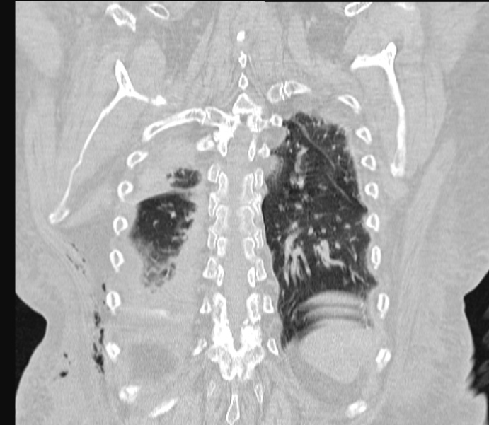 Barotrauma due to mechanical ventilation (Radiopaedia 28079-28336 Coronal lung window 75).jpg