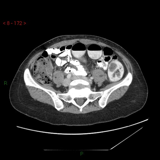 Bartholin gland cyst (Radiopaedia 54904-61181 A 43).jpg