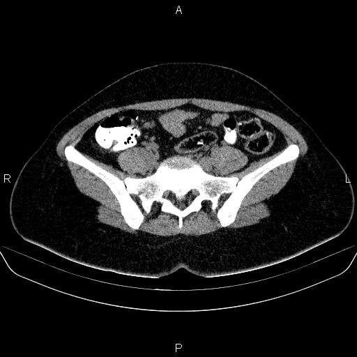 File:Bartholin gland cyst (Radiopaedia 62635-70930 Axial non-contrast 18).jpg