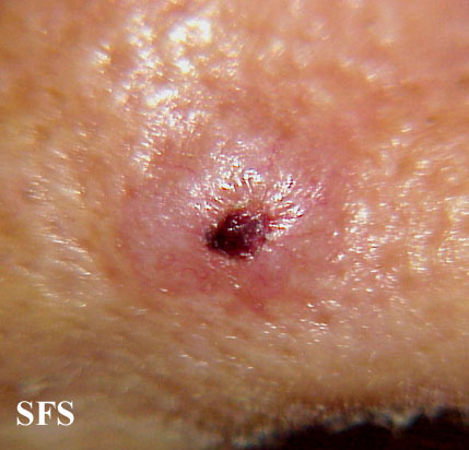 Basal Cell Carcinoma (Dermatology Atlas 94).jpg