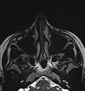 Basal cell carcinoma - nasal region (Radiopaedia 70292-80365 Axial Gradient Echo 29).jpg