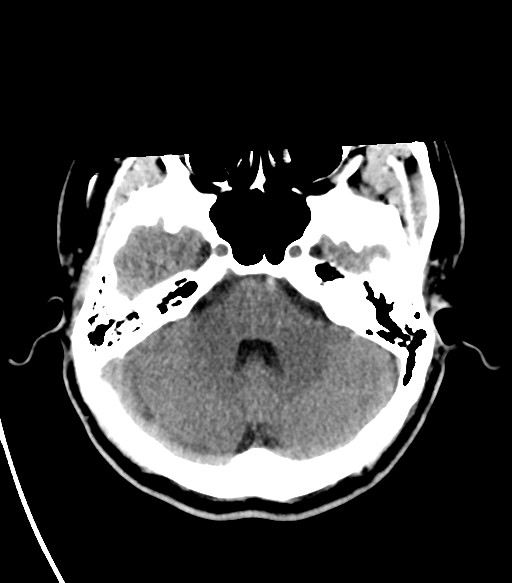 File:Basal ganglia hemorrhage - hypertensive (Radiopaedia 42227-45304 Axial non-contrast 8).png