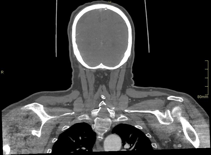 Basilar artery aneurysm (Radiopaedia 56261-62932 B 62).jpg