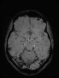 Basilar artery perforator aneurysm (Radiopaedia 82455-97733 Axial SWI 22).jpg