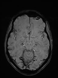 File:Basilar artery perforator aneurysm (Radiopaedia 82455-97733 Axial SWI 23).jpg