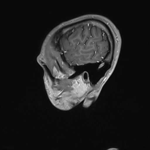 File:Basilar artery perforator aneurysm (Radiopaedia 82455-97733 G 20).jpg