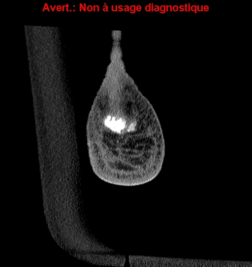 Baxter neuropathy (Radiopaedia 25988-26125 Coronal non-contrast 58).jpg