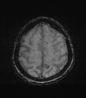 File:Behavioral variant frontotemporal dementia and late onset schizophrenia (Radiopaedia 52197-58083 Axial SWI 62).png