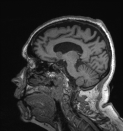 Behavioral variant frontotemporal dementia and late onset schizophrenia (Radiopaedia 52197-58083 Sagittal T1 59).png